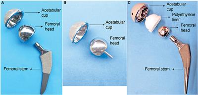 Mechanisms of Adverse Local Tissue Reactions to Hip Implants